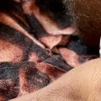 スーダン栄養危機