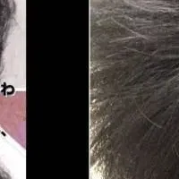 頭皮鍼施術の魅力