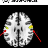 社交不安症の脳研究