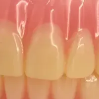 3Dプリンター義歯保険適用