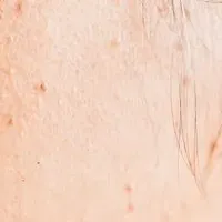 シミ取り後のケア